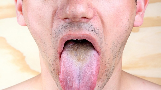 Mundkrankheiten: Sieben fiese Leiden an Zunge, Mundschleimhaut und